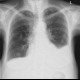 Metastatic disease of the lung: X-ray - Plain radiograph